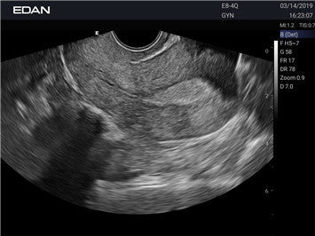 Edan Acclarix AX3 Compact Color Doppler Ultrasound System Minerva Health Solutions Inc.