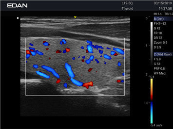 Edan Acclarix AX3 Compact Color Doppler Ultrasound System Minerva Health Solutions Inc.