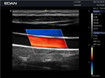 Edan Acclarix AX3 Compact Color Doppler Ultrasound System Minerva Health Solutions Inc.