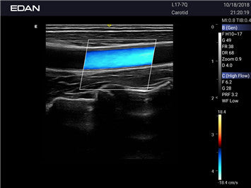 Edan Acclarix AX3 Compact Color Doppler Ultrasound System Minerva Health Solutions Inc.