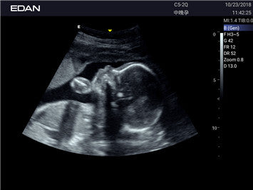 Edan Acclarix AX3 Compact Color Doppler Ultrasound System Minerva Health Solutions Inc.