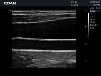 Edan Acclarix AX3 Compact Color Doppler Ultrasound System Minerva Health Solutions Inc.