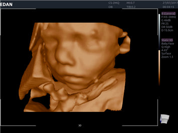 Edan Acclarix AX8 Ultrasound Machine