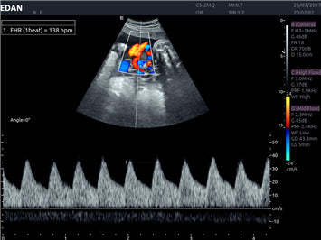 Edan Acclarix AX8 Ultrasound Machine Minerva Health Solutions Inc.