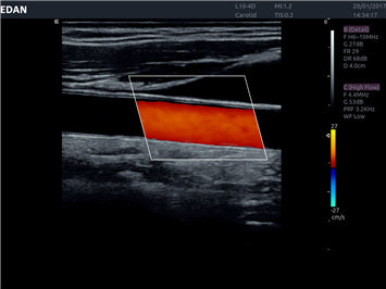 Edan Acclarix AX8 Ultrasound Machine Minerva Health Solutions Inc.
