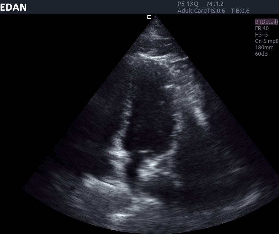 Edan Acclarix AX8 Ultrasound Machine Minerva Health Solutions Inc.