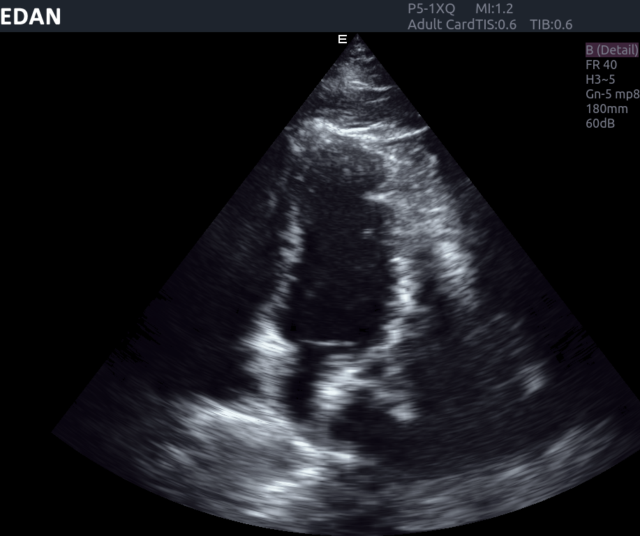 Edan Acclarix AX8 Ultrasound Machine
