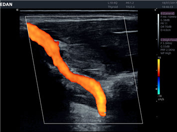 Edan Acclarix AX8 Ultrasound Machine