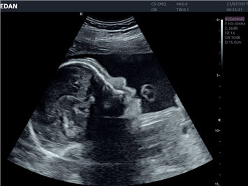 Edan Acclarix AX8 Ultrasound Machine