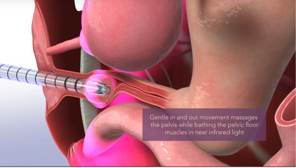 SoLa Pelvic Therapy SoLa