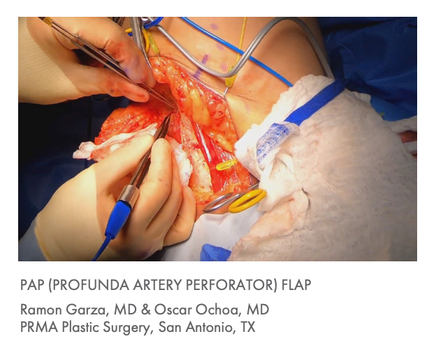 Lone Star Microvascular Breast Surgery Retractor System and Elastic Stays