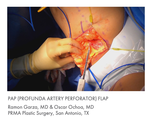 Lone Star Microvascular Breast Surgery Retractor System and Elastic Stays