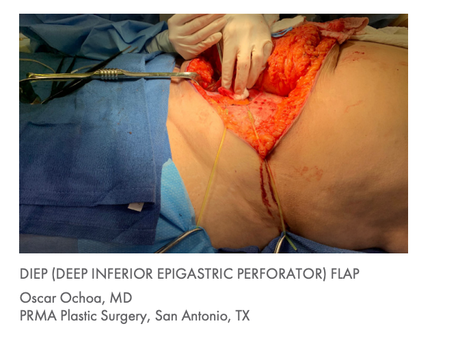 Lone Star Microvascular Breast Surgery Retractor System and Elastic Stays