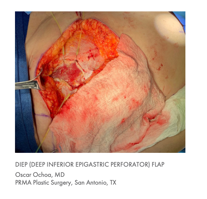 Lone Star Microvascular Breast Surgery Retractor System and Elastic Stays