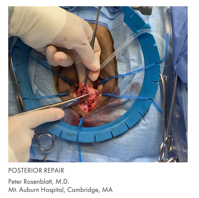 Lone Star Gynecology Retractor System and Elastic Stays