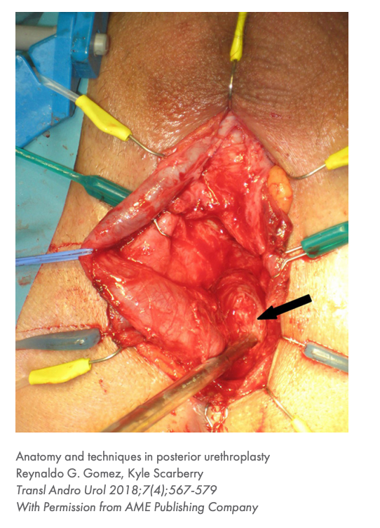 Lone Star Reconstructive Urology Retractor System and Elastic Stays