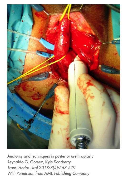 Lone Star Reconstructive Urology Retractor System and Elastic Stays