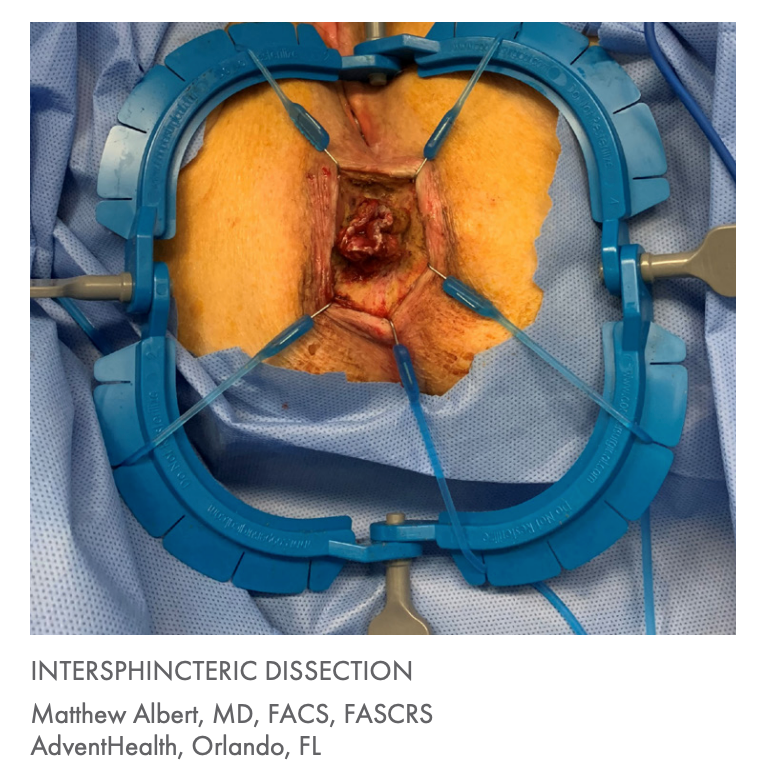 Lone Star Colorectal Retractor System and Elastic Stays