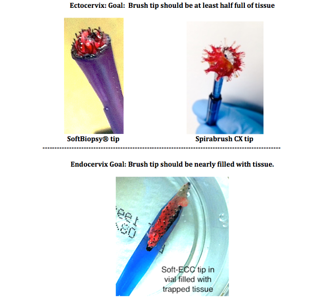 SpiraBrush CX Gynecological Biopsy Device