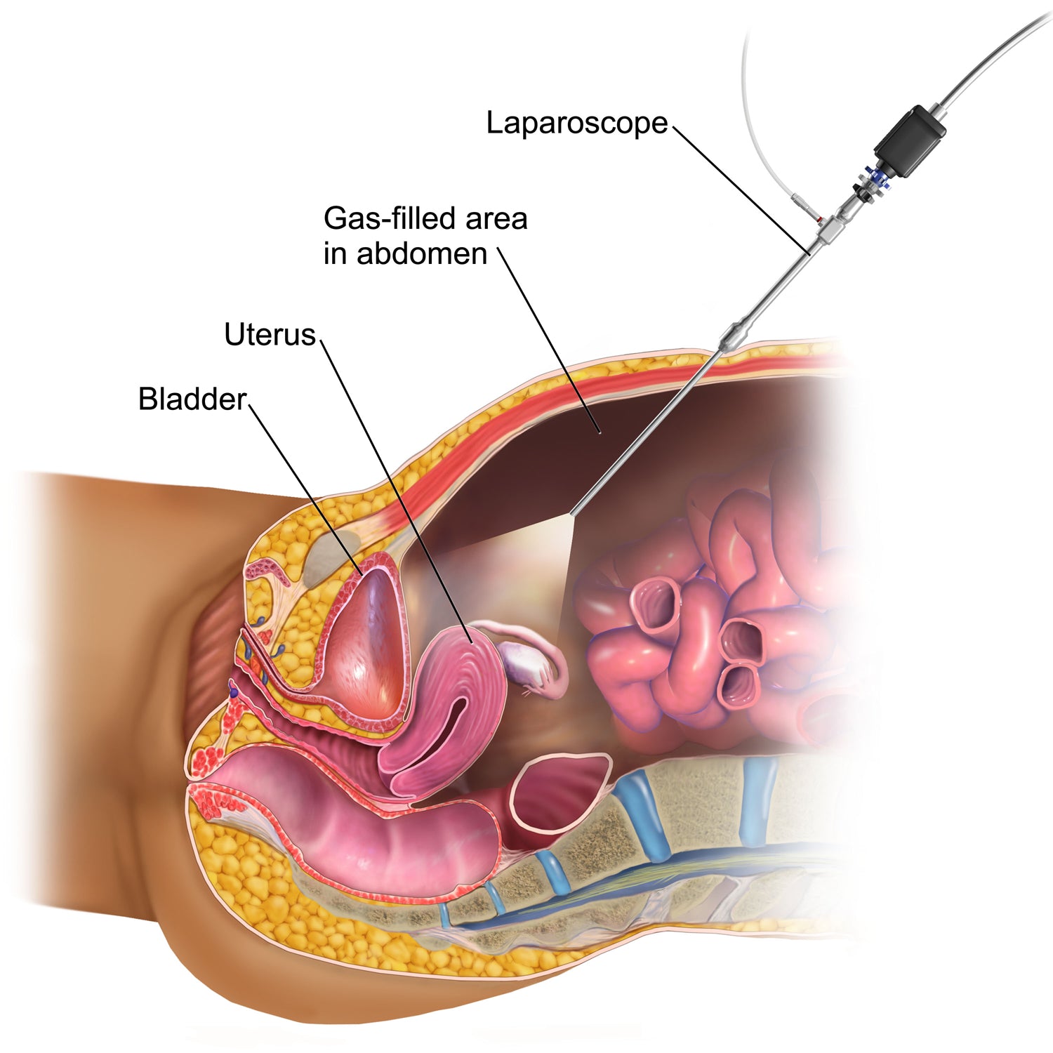 Laparoscopic Gynecologic Surgeries: Procedures & Recovery