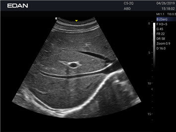 Edan Acclarix AX3 Compact Color Doppler Ultrasound System