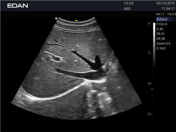 Edan Acclarix AX3 Compact Color Doppler Ultrasound System