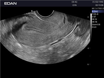 Edan Acclarix AX3 Compact Color Doppler Ultrasound System